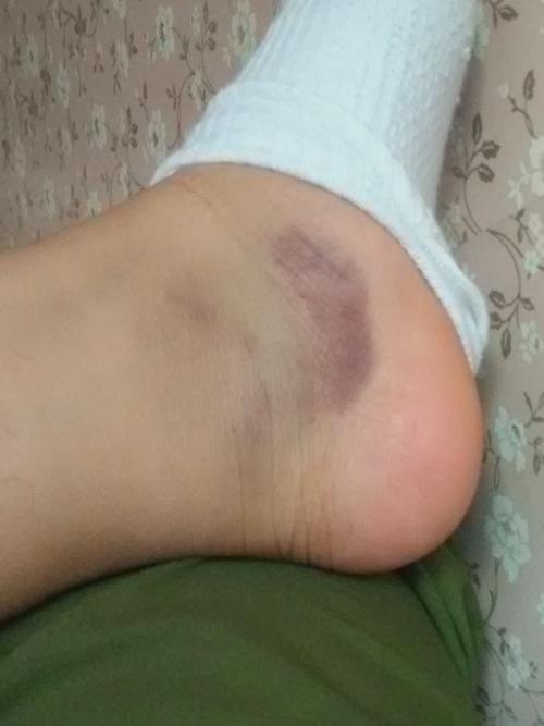 军训之前摔了一跤,腿疼,但是脚不怎么疼,可是脚紫的厉害,没什么大