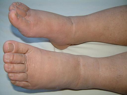 肾病患者也会下肢水肿,但肝癌患者的水肿,一般发生在脚踝和下肢,甚至