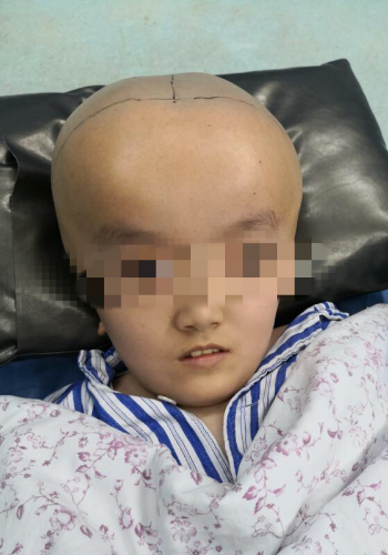 甘肃"巨头娃娃"在湖南接受手术 "新脑袋"被成功缩小7厘米_湖南频道_凤