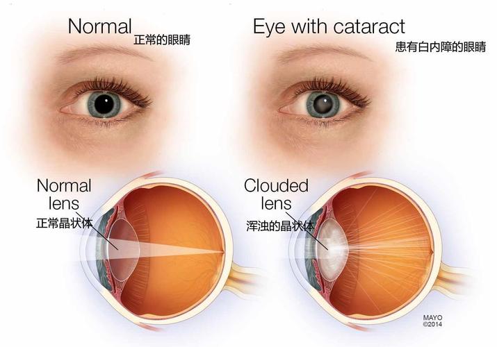 白内障引起视力障碍模式图(图片来源:eyeworksgroup.com)