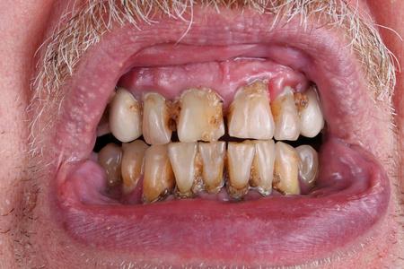 坏牙齿一个老年人的牙齿被龋齿和糟糕的浪费食物宏观宠坏了.
