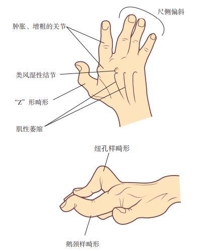 手指肿痛僵硬有结节预示着哪些疾病医生详述常见的6种病因