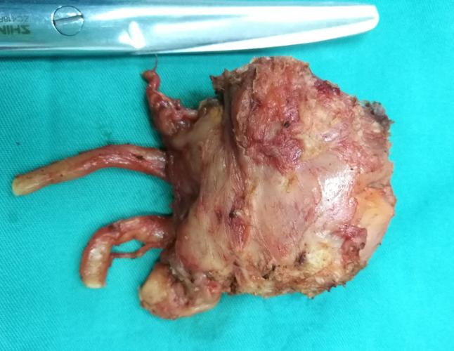 前列腺癌的微创手术方式——腹腔镜下根治性前列腺切除术 - 好大夫