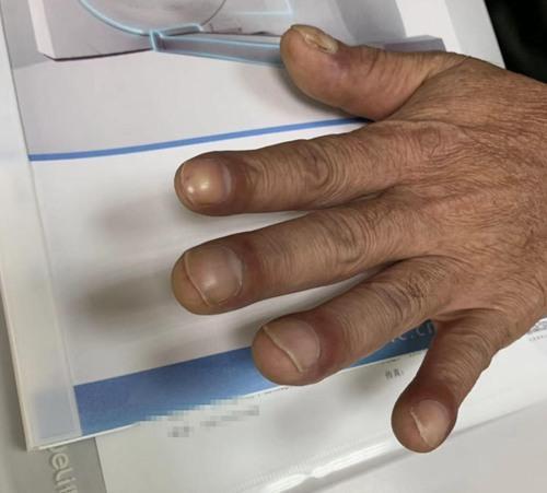 手指出现杵状指一定要警惕可能患上肿瘤了