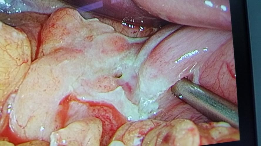 急性胃十二指肠溃疡穿孔如何防治 - 好大夫在线