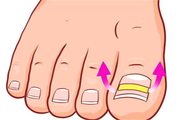 甲沟炎会变成灰指甲吗 甲沟炎会导致什么后果