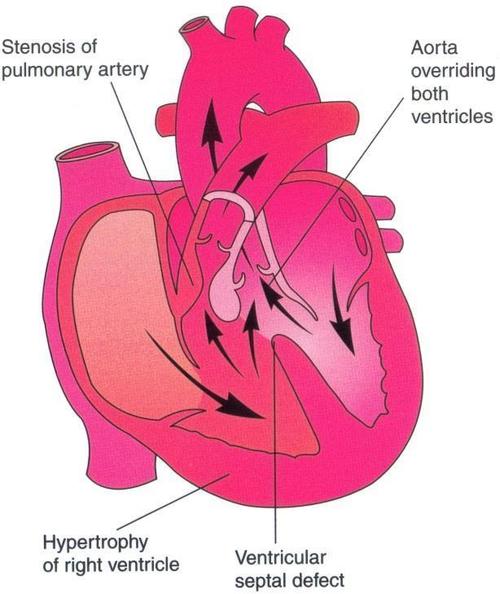 法洛氏四联症最常见的紫绀型先天性心脏病