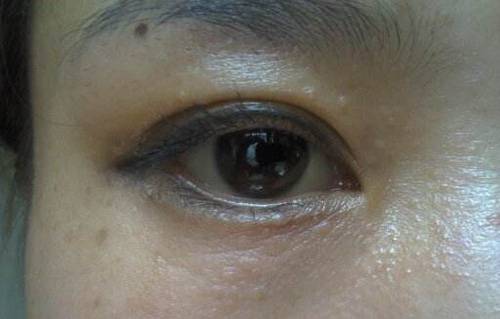 眼部扁平疣会带来哪些危害