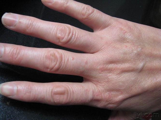 双手反复红色丘疹伴瘙痒半年余甲真菌病接触性皮炎