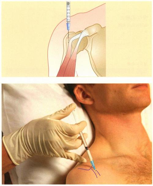 《镇痛注射技术图谱》——上肢注射技术:肱二头肌-长头腱