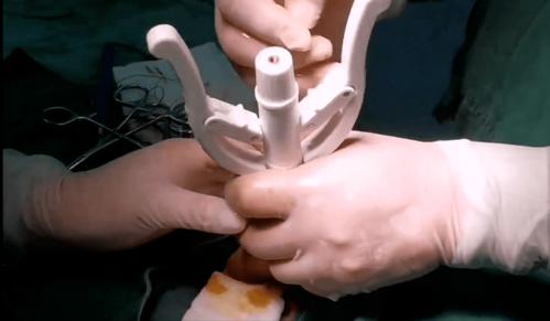 手术演示丨吻合器包皮环切术