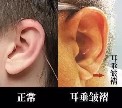 这道耳垂皱褶在我们国家也称为冠心沟,脑动脉硬化耳褶征.