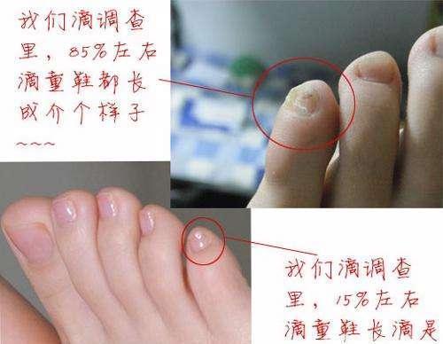 小脚趾上的指甲为什么是两瓣儿真的是汉族人的独有特征吗