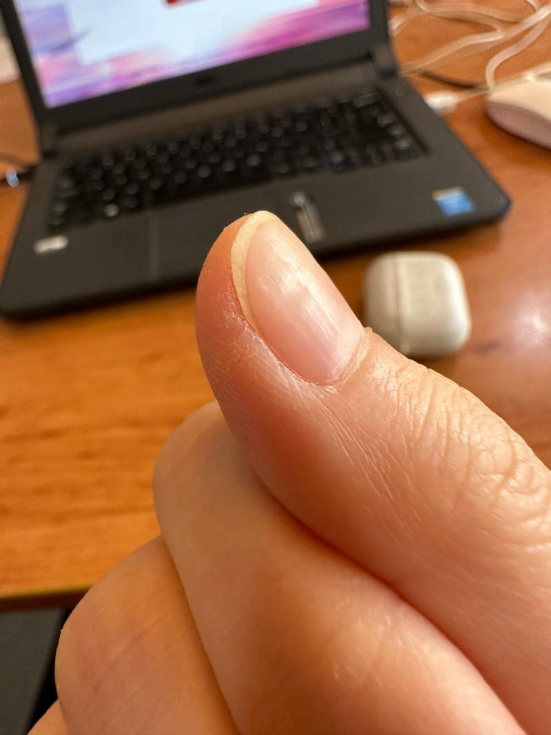 指甲凹陷是什么原因 十个指甲,每个指甲中部凹进去一点点,个别指甲也