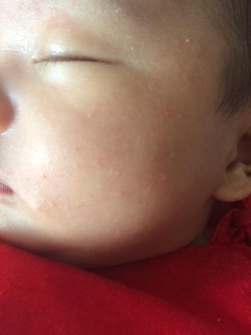 新生儿脸上起了像粉刺一样的东西,请问是湿疹吗?要怎么办?