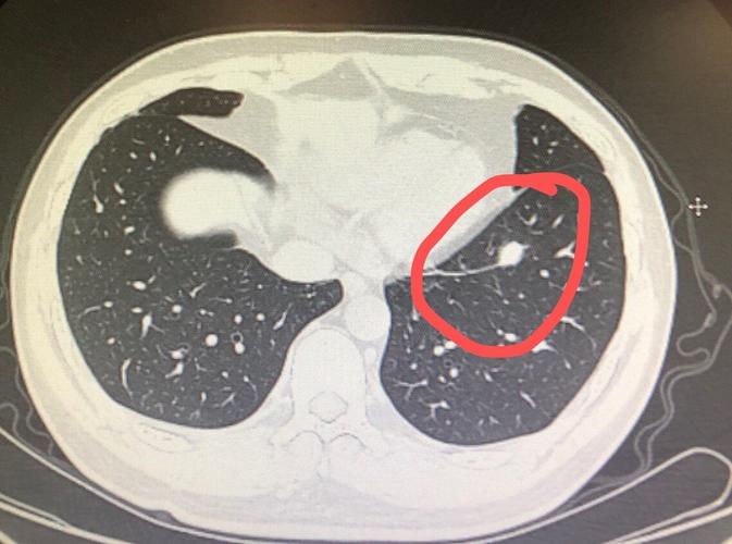 左下肺一实性结节(肉芽肿)_肺部疾病_肺部疾病相关疾病 - 好大夫在线