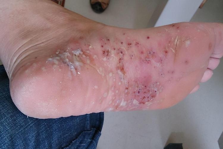 脚掌脓疱病的患者常常在两侧脚底对称性出现点状或是豆状大小的脓疱