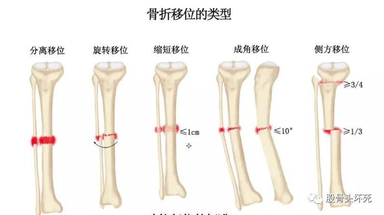 2,缩短移位在成人下肢骨折不超过1cm;儿童若无骨骺损伤,下肢缩短在2cm