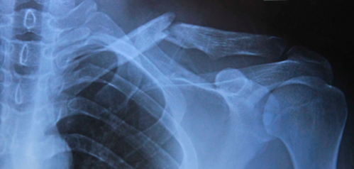 injury:急性中段锁骨骨折手术固定的并发症