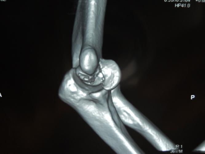 罕见的单纯左肱骨滑车骨折一例与大家分享