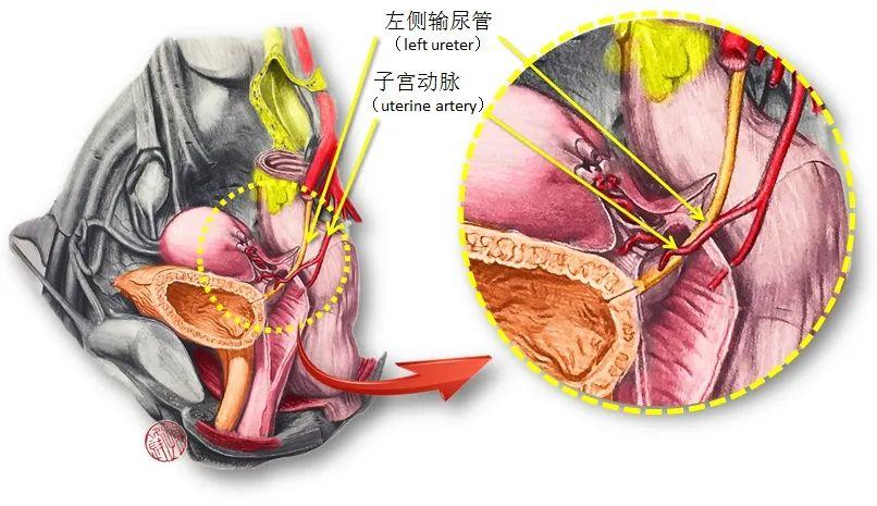 图(1):输尿管盆部与子宫动脉↑↑↑"桥下流水":女性输尿管盆部位于