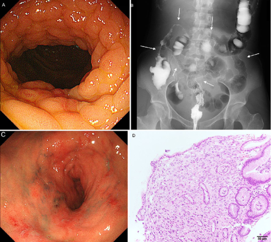 藏形匿影—奇怪的肠道"克罗恩病"|结肠|胃癌|肿瘤|克罗恩病|肠道