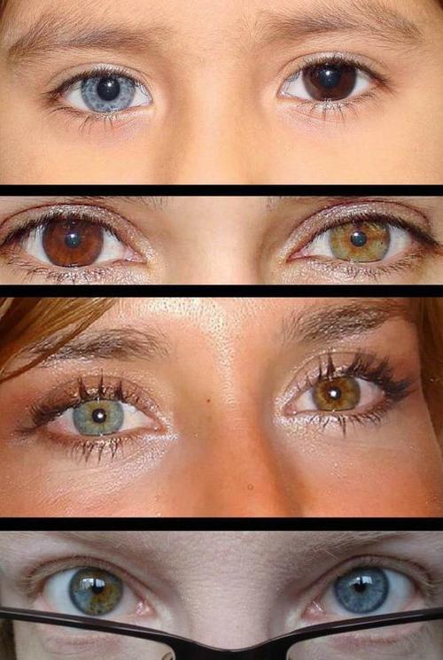 女模特拥有迷人双色瞳孔 专家提醒可能是病