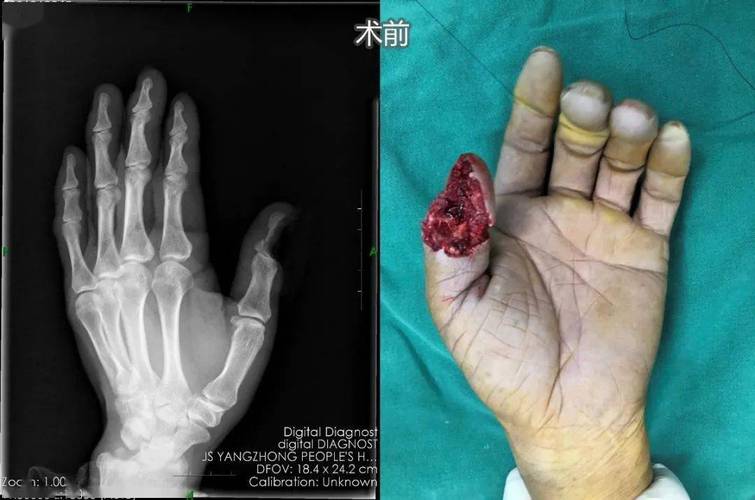 拇指再造手术图片 ▼56岁的魏先生,工作时左手大拇指不慎被电锯