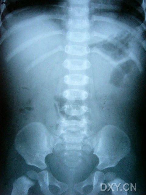小儿肠套叠的影像诊断与治疗