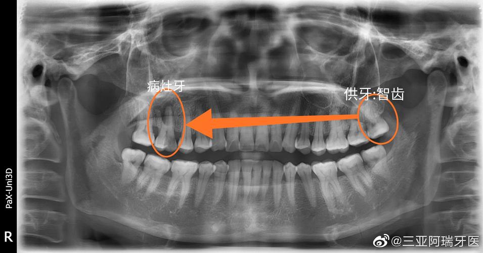 左上智齿移植到右上第一磨牙位置