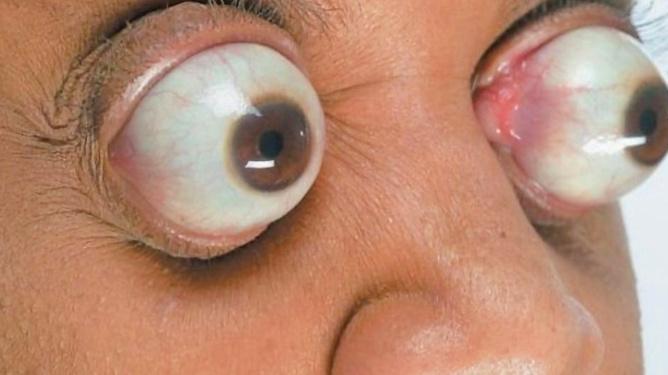 眼球最突出的女人突出眼眶11毫米一打喷嚏眼睛就掉下来