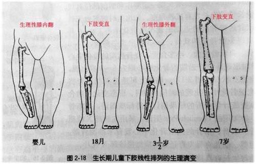 儿童"o"型腿及"x"型腿:了解儿童膝内翻与膝外翻 (原创)