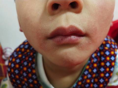 宝宝嘴周边出现这种情况,医生说湿疹,也没用药现在