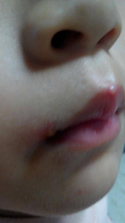 孩子嘴上的疱疹,比较像病毒疱疹,唇间那个看得比较清楚,嘴角的那颗