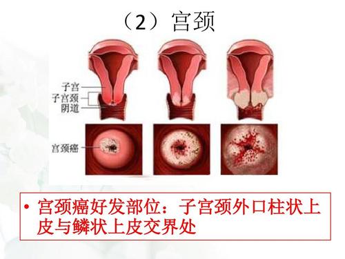 (2)宫颈   宫颈癌好发部位:子宫颈外口柱状上 皮与鳞状上皮交界处