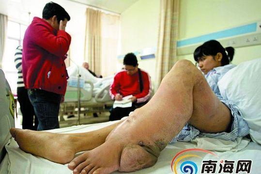 小雪的左腿如不及时手术将截肢 南国都市报记者 刘孙谋摄