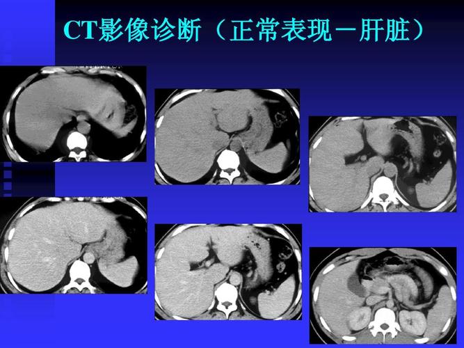 腹部ct等等 ct影像诊断(正常表现-肝脏) 影像诊断(正常表现-肝脏)
