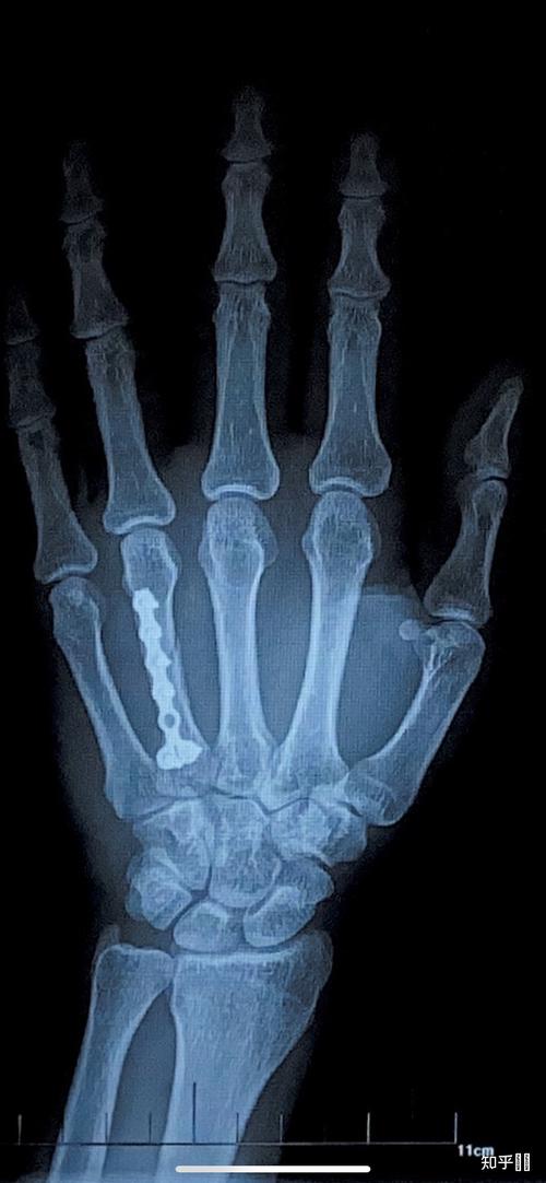 右手第四掌骨骨折保守治疗的第16天恢复的是否不太理想