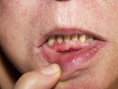 牙周炎牙龈区的炎症过程. 牙齿脖子的暴露. 医生检查口腔.