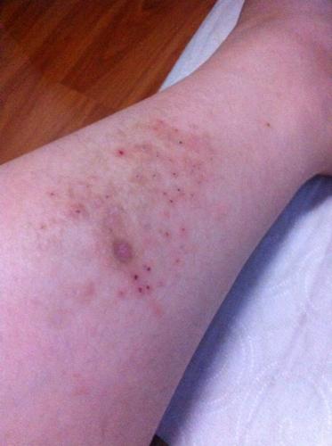去年夏天开始小腿长了好多疹子 像是湿疹但没去医院看 夏天过去就没了