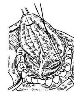 下颌下腺导管结石摘除术