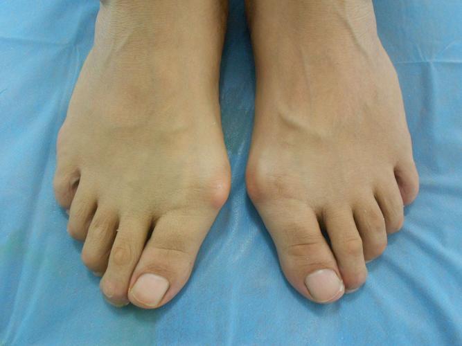 首页 拇指外翻(大脚骨) 病因   正常人拇趾有10°左右的向外偏斜