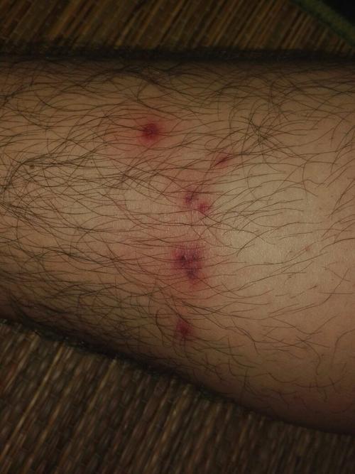 这天小腿上张了几个红肿还带脓包的痘是咋回事