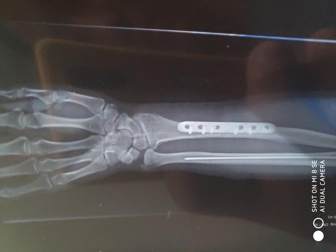 右手桡骨中断骨折钢板固定后,一月复查结果是;右手桡骨中断骨折内固定