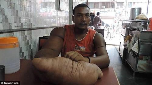 > 正文   据《每日邮报》报道,印度25岁男子巴布卢因患有局部巨人症