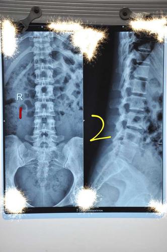 我让她去医院拍摄 腰椎正侧位的x-ray,骨盆正位片.