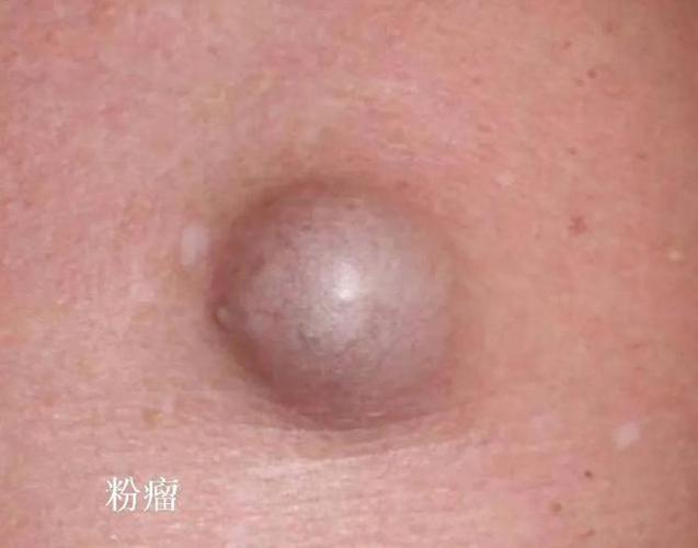 潍坊市人民医院专家问您讲解"粉瘤"——皮脂腺囊肿到底是什么?