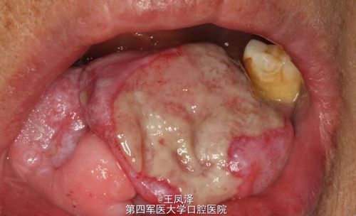 罕见巨大牙龈瘤一例