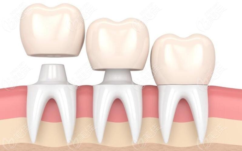 乳牙预成冠是什么材质做成的与普通牙冠相比有什么区别