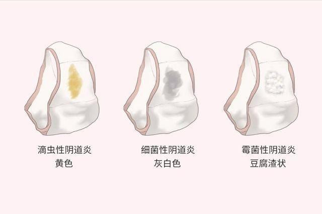 宫颈管以及子宫内膜腺体分泌物等混合而成,在临床上被称之为白带,正常